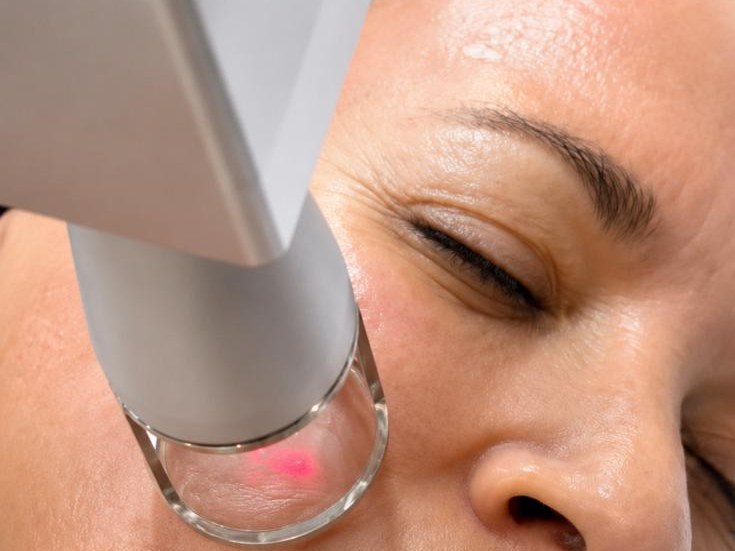 Fractional CO2 laser hand-piece applied to the cheek, the red aiming spot visible