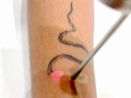 Séance de détatouage au laser, vue de dos — le visage n’apparaît pas