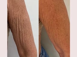 Peau du bras avant et après un traitement de fermeté cutanée