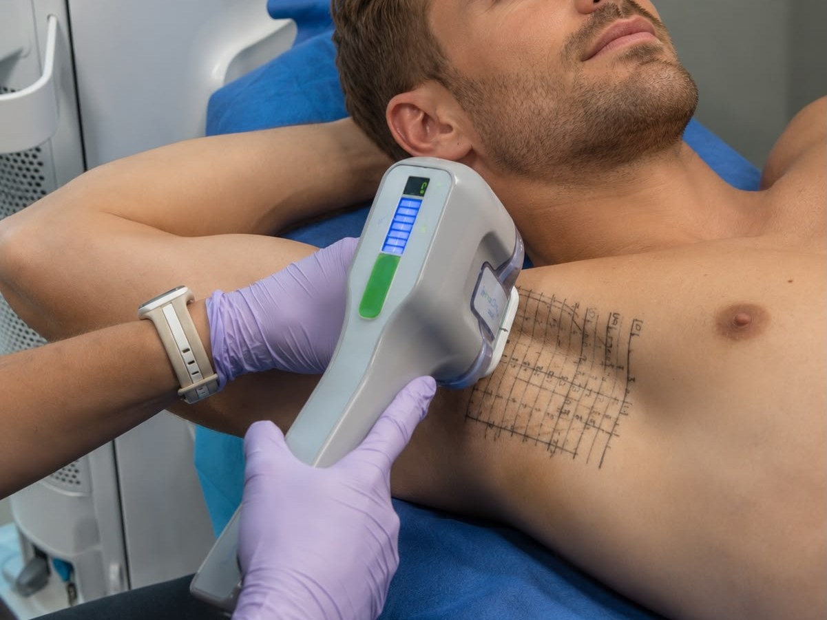 Treatment of excessive underarm sweating, the mapping grid drawn on the skin