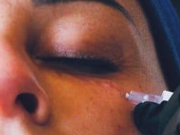 Décolleté après une séance de micro-injections, le quadrillage des points visible