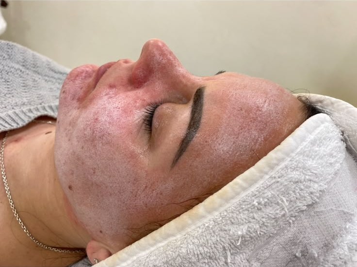 Visage au repos après un peeling, la rougeur uniforme de la peau traitée