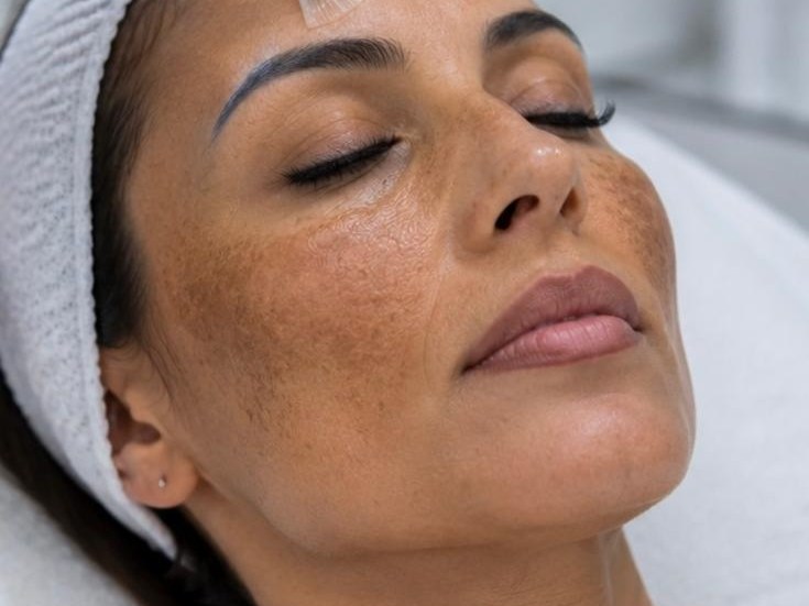 Peau du visage marquée par un mélasma, plaques pigmentées sur les pommettes et le front