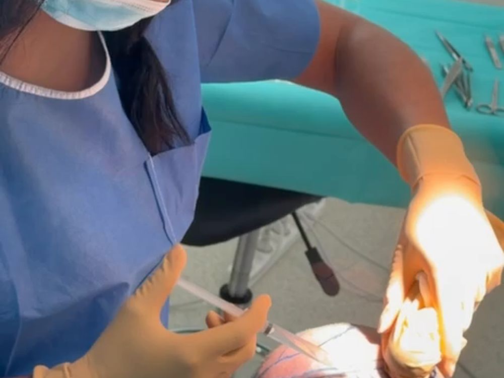 Injection réalisée à la seringue fine sur le cuir chevelu tracé