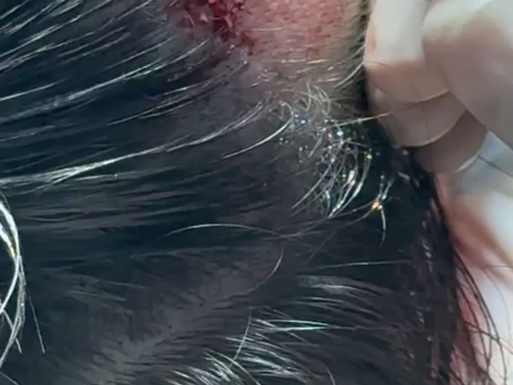 Greffons implantés au sein d’une chevelure longue